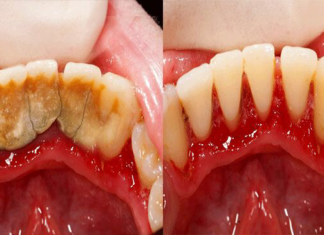 grace community church sun valley dress code : Astuce maison pour enlever le tartre dentaire soi-même