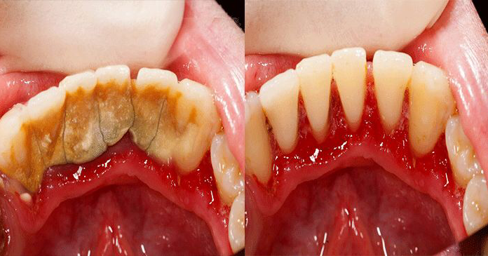 grace community church sun valley dress code : Astuce maison pour enlever le tartre dentaire soi-même